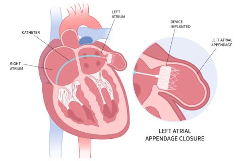 Left Atrial Appendage Closure (LAAC) - Auburn Cardiology Centre